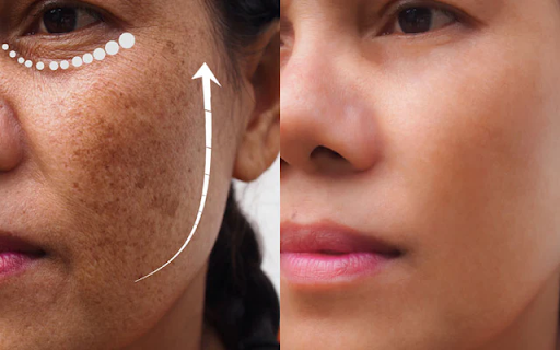 Which Is Better: Hydroquinone Or Kojic Acid?