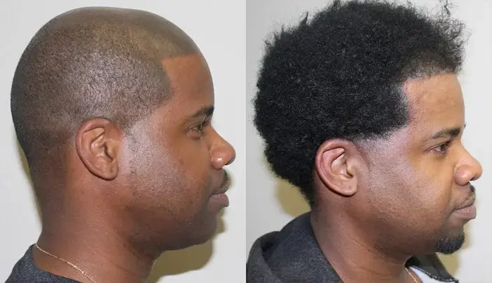 The Health And Beauty Benefits Of Afro Hair Transplant