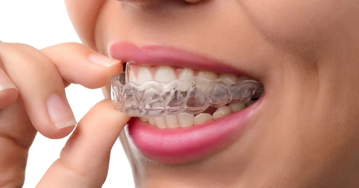 Things To Know Before Getting Invisalign Treatment