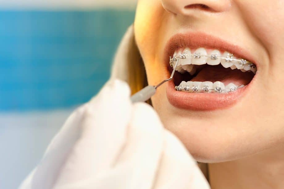 Your Go-to Guide For Adult Braces In Alpharetta