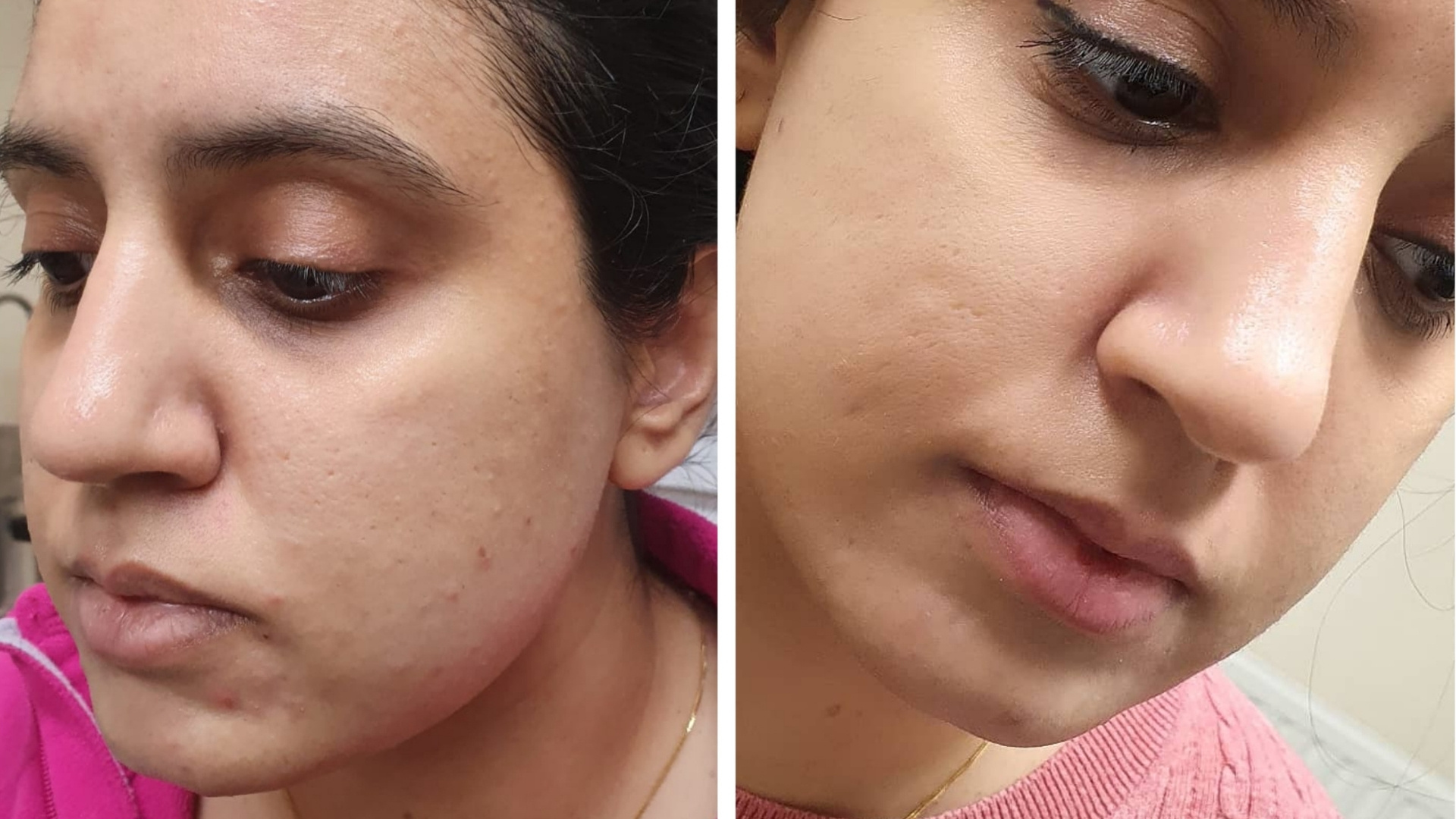 Looking For Skin Rejuvenation Without Surgery? Here's What To Know