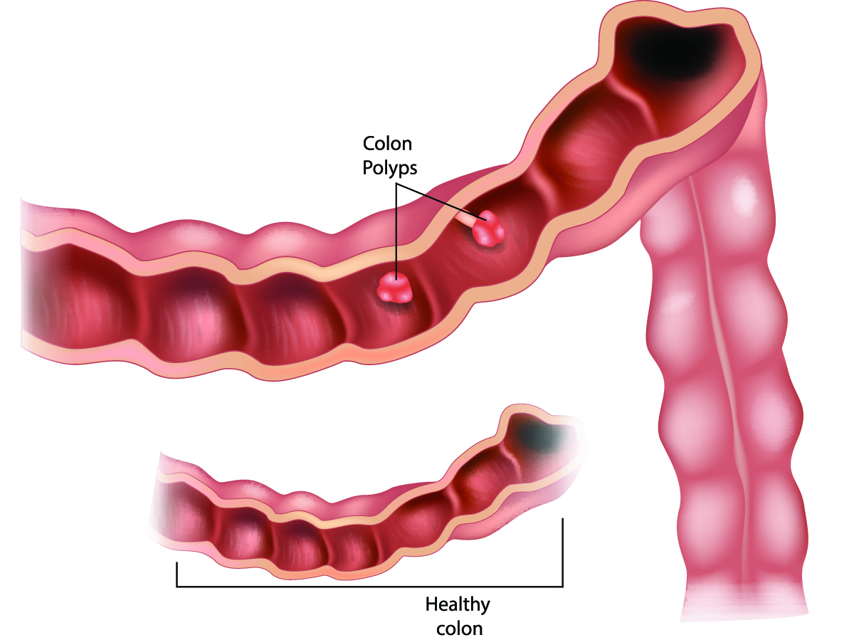 Understanding Colon Polyps And Why Monitoring May Be Important