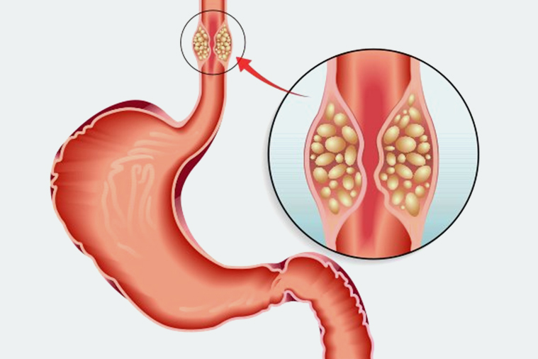 A Detailed Look At Esophageal Malignancies: Causes, Diagnosis, And Advanced Treatments